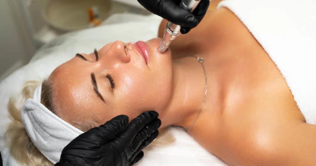Woman getting SkinPen microneedling facial from a professional in meridian ID 1